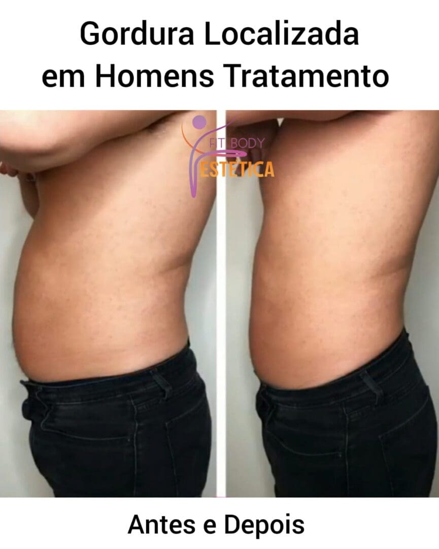 Gordura Localizada Em Homens Tratamento Fit Body Est Tica