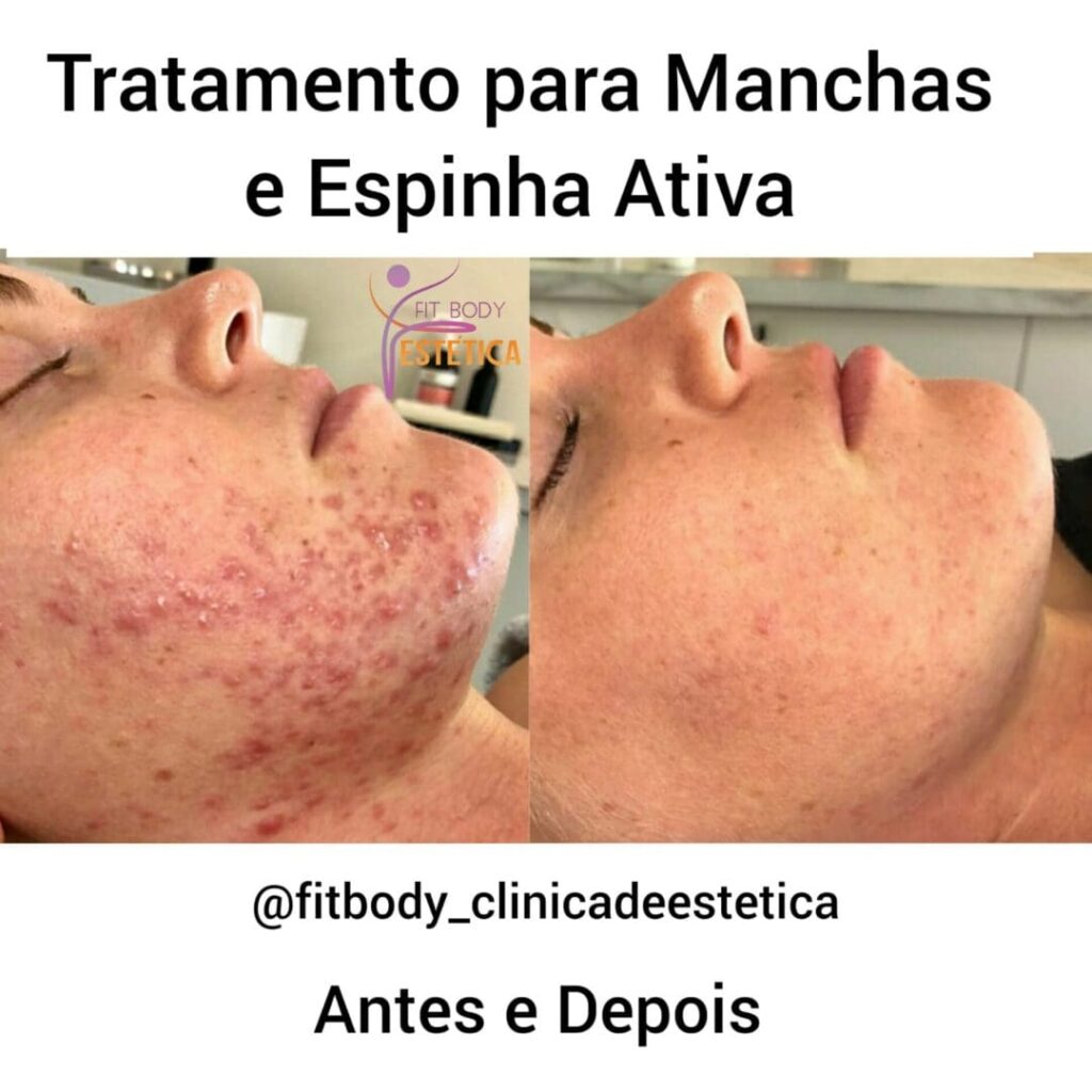Manchas e Espinha Ativa Tratamento