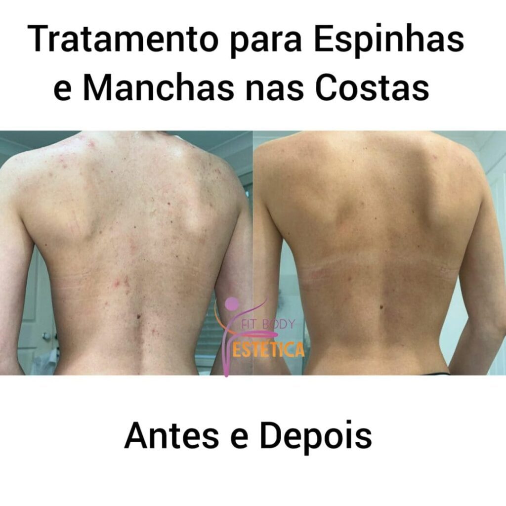 Tratamento para Espinhas e Manchas nas Costas