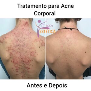 Acne Corporal