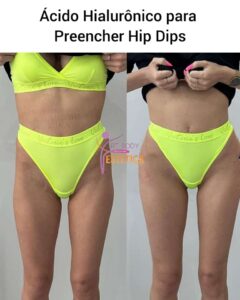 Ácido Hialurônico para Preencher Hip Dips