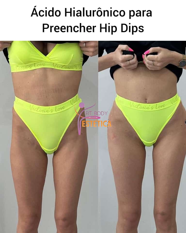 Ácido Hialurônico para Preencher Hip Dips - Clínica Fit Body Estética