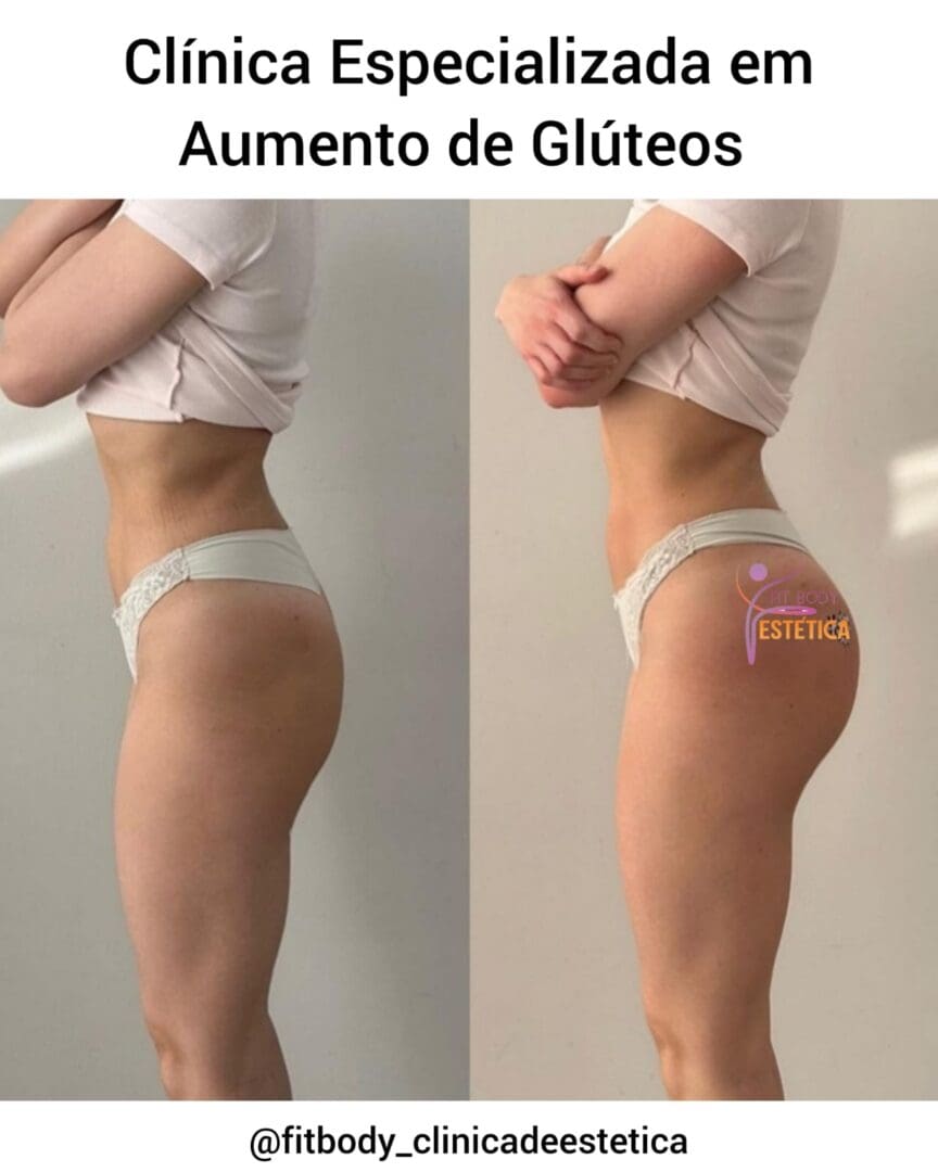 Aumento de Glúteos SP - Clínica Fit Body Estética