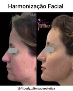 Clínica de Harmonização Facial em Moema