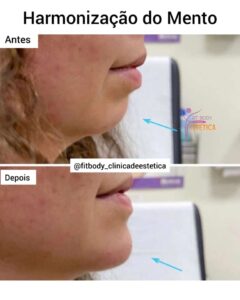 Harmonização do Mento Antes e Depois