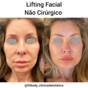 Lifting Facial Não Cirúrgico