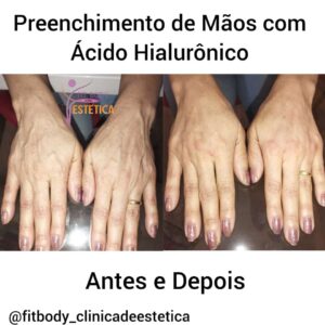 Preenchimento de Mãos Antes e Depois