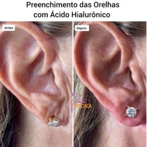 Preenchimento de Orelha