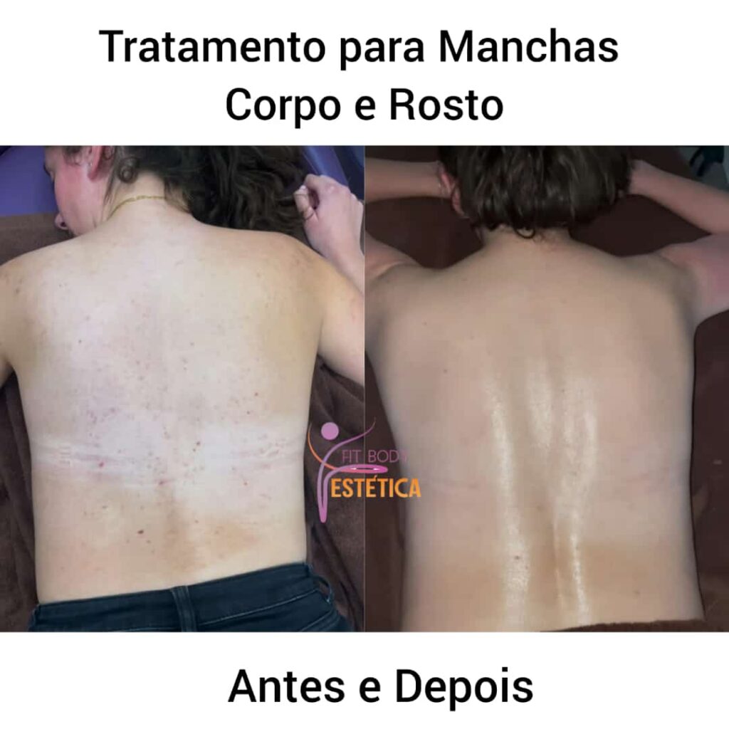 Manchas no Corpo Tratamento