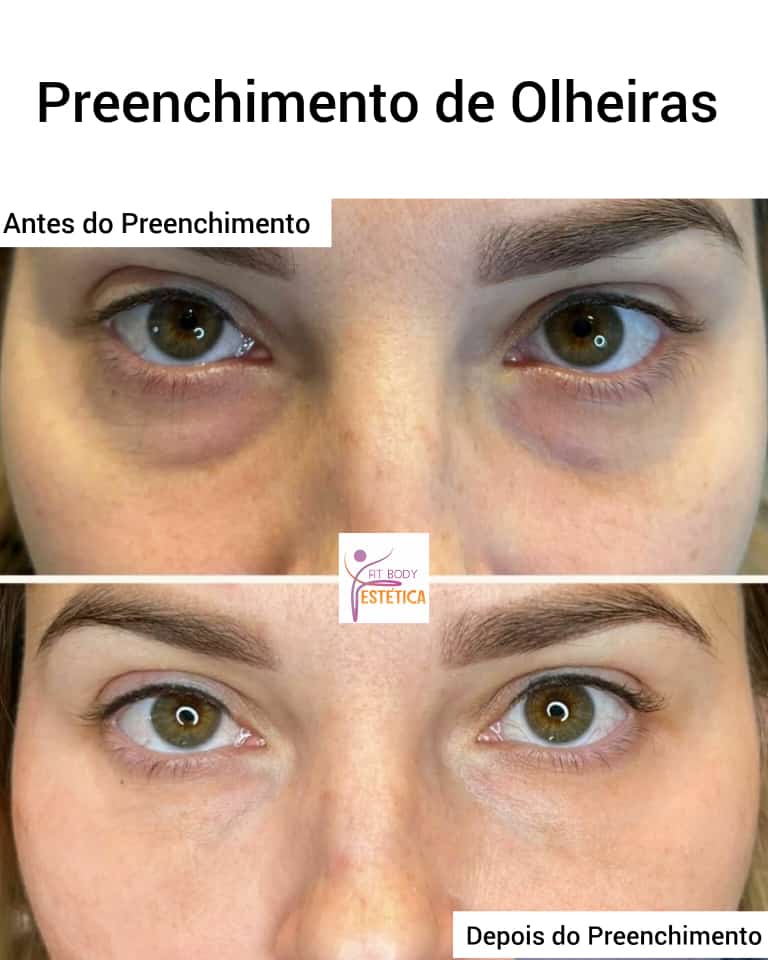 Preenchimento de Olheiras Antes e Depois