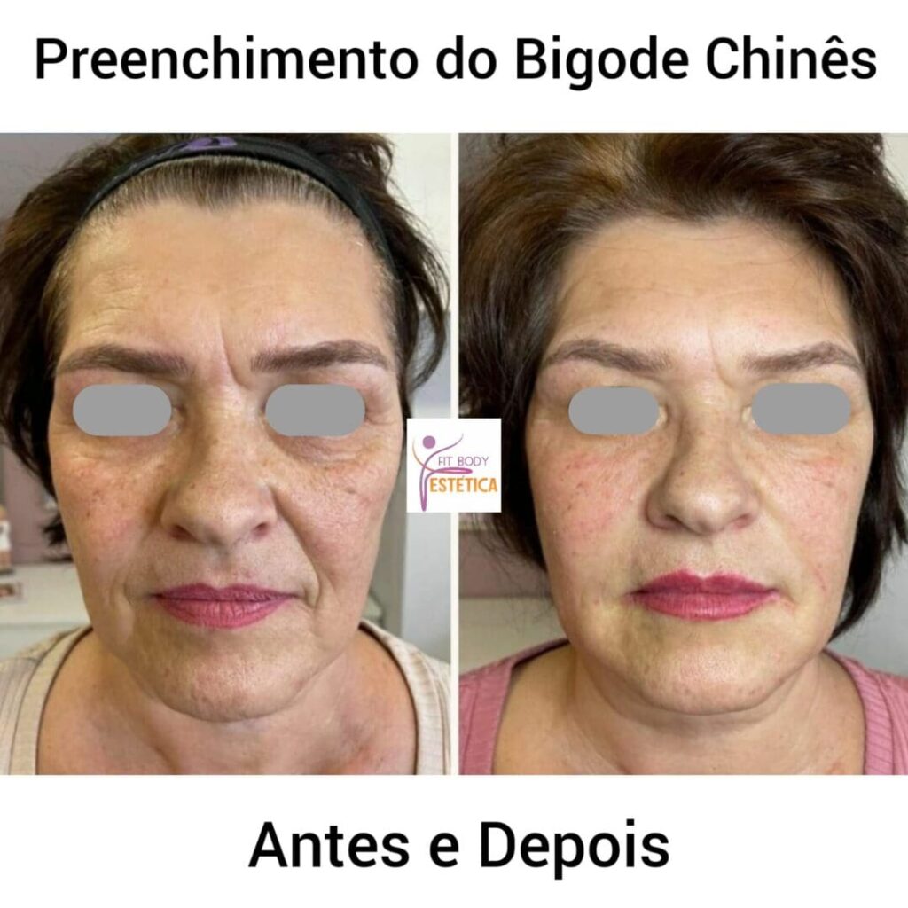 Arquivos Preenchimento Do Bigode Chinês Antes E Depois Clínica Fit Body Estética 