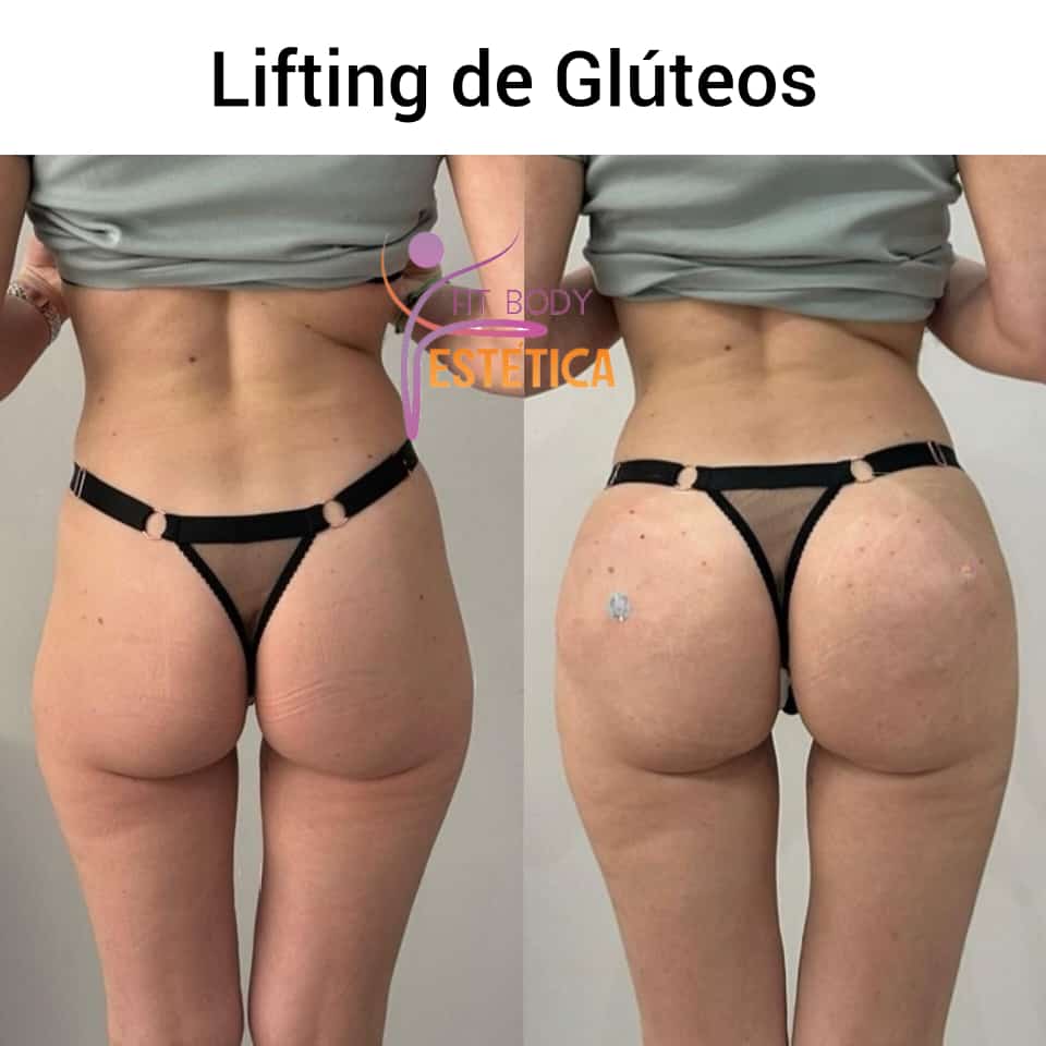 Lifting de Glúteos