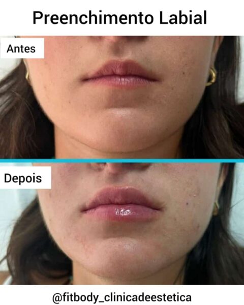 Preenchimento Labial Como é Realizado Clínica Fit Body Estética