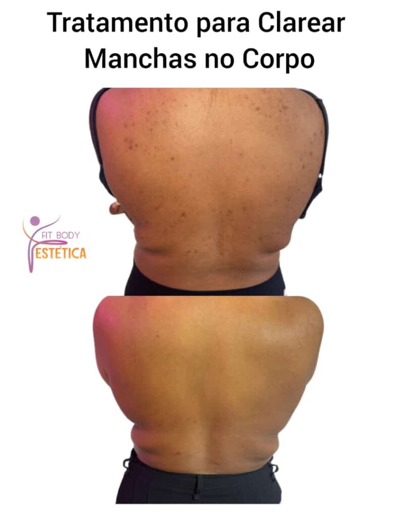 Tratamento para Clarear Manchas Escuras