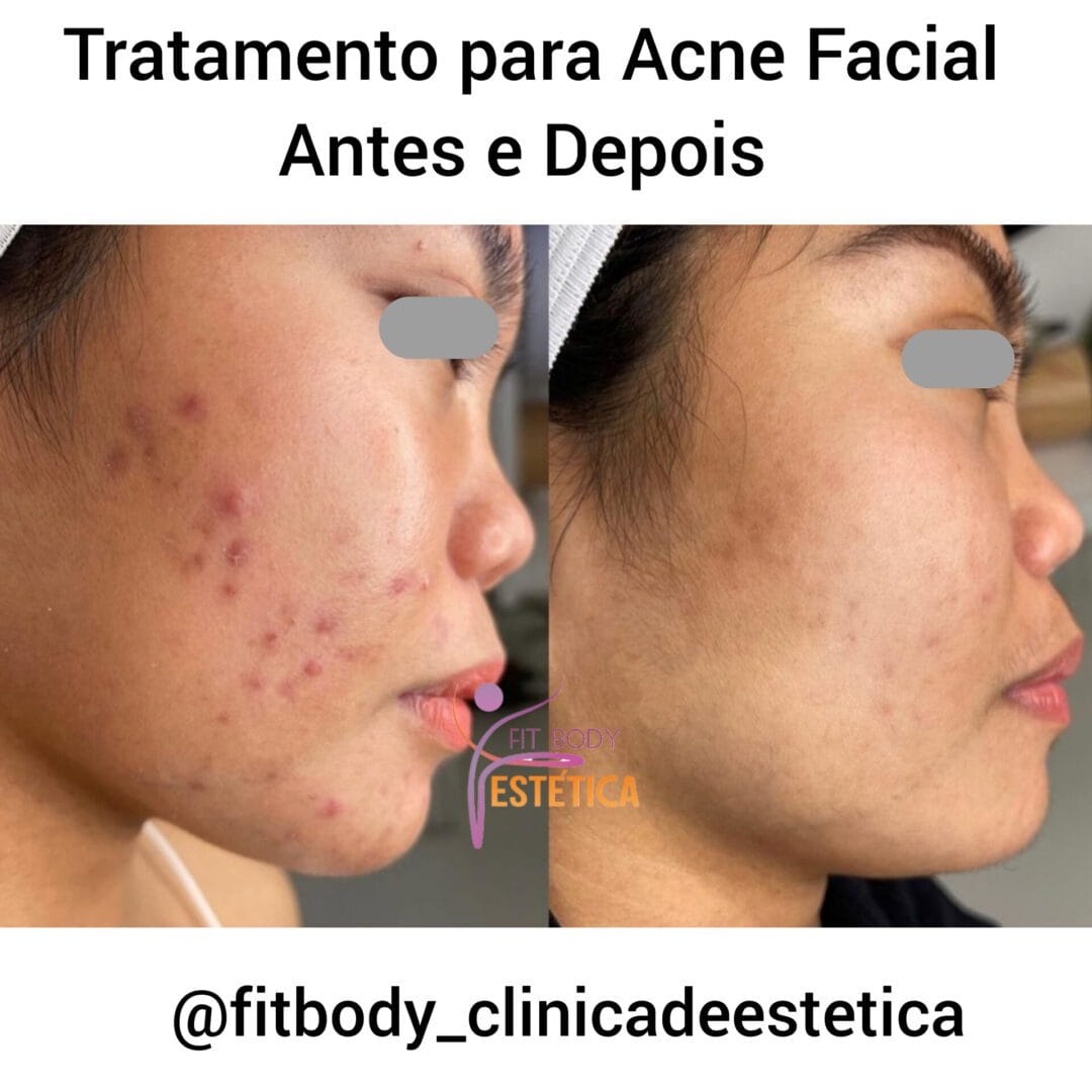 Acne Facial Como é Realizado o Tratamento Clínica Fit Body Estética