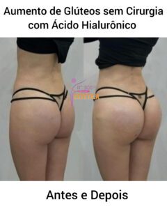 Aumento de Glúteos sem Cirurgia com Ácido Hialurônico