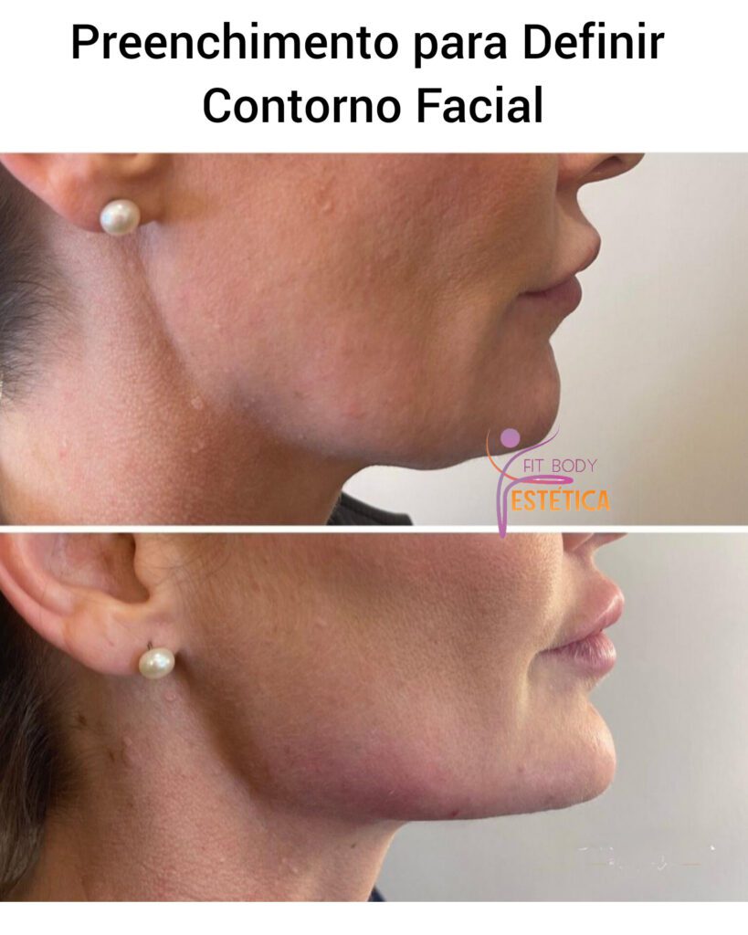 Preenchimento para Definir Contorno Facial