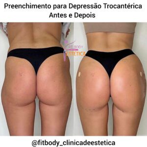 Preenchimento para Depressão Trocantérica Antes e Depois