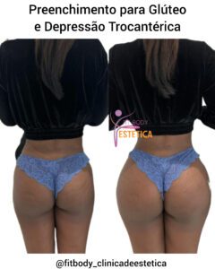 Preenchimento para Glúteo e Depressão Trocantérica