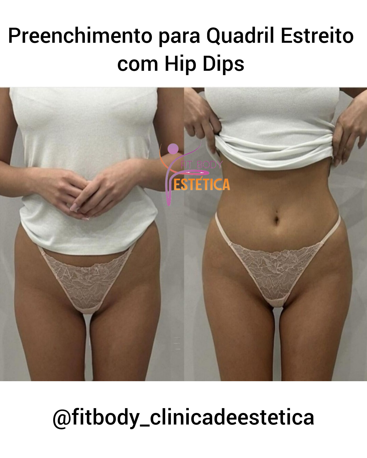 Aumento de Quadril para Tratar Hip Dips - Clínica Fit Body Estética