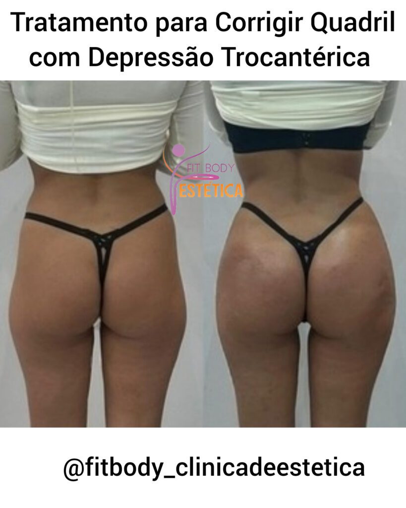 Tratamento para Corrigir Quadril com Depressão Trocantérica