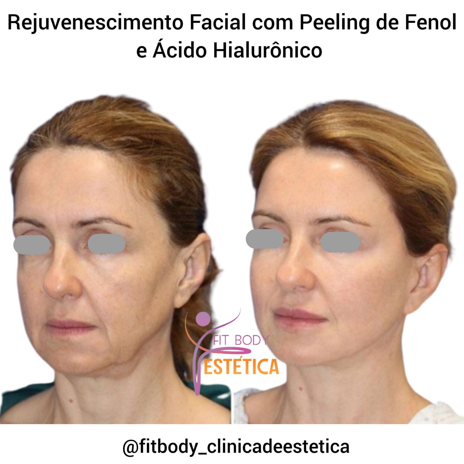 Peeling De Fenol Antes E Depois Clínica Fit Body Estética 4484