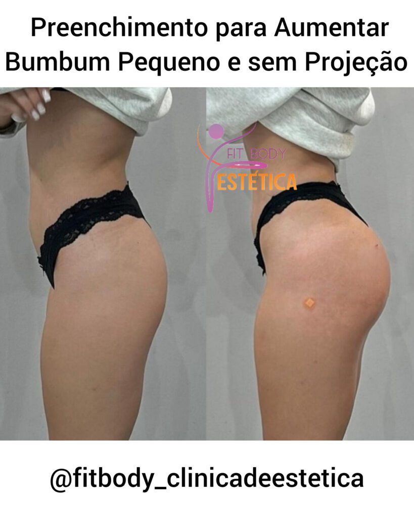 Preenchimento para Aumentar Bumbum Pequeno e sem Projeção