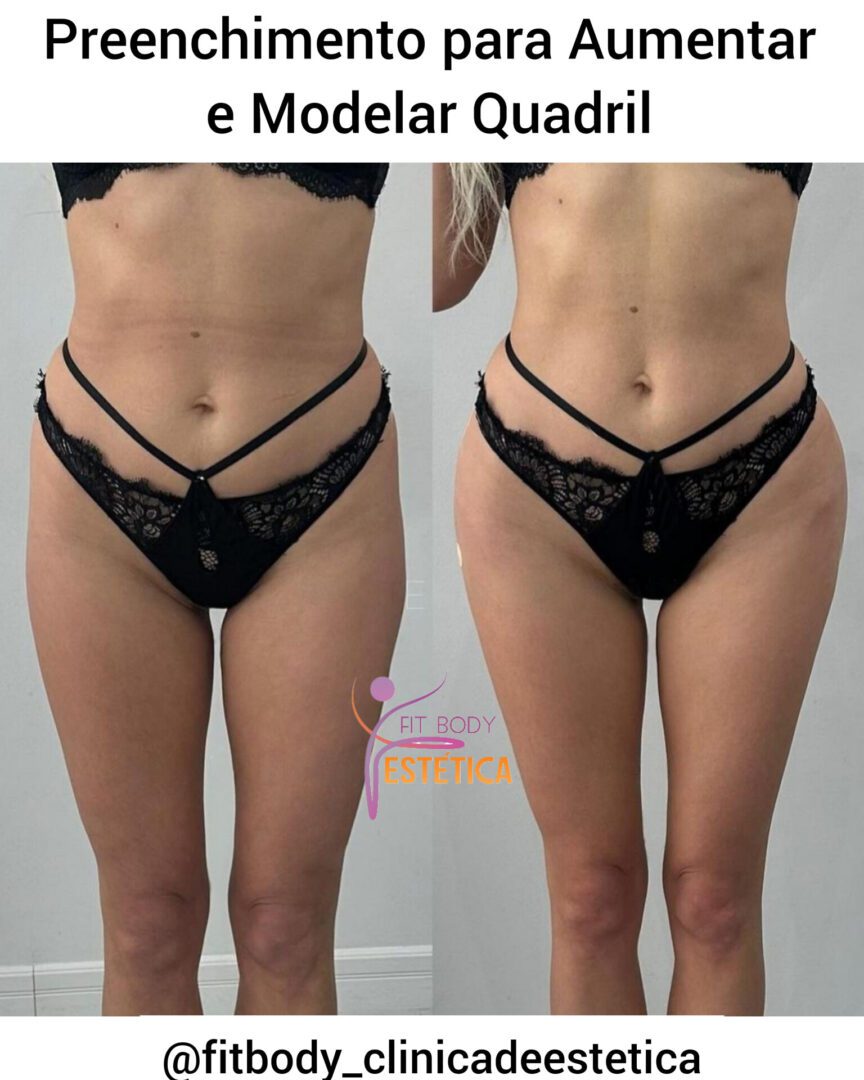 Preenchimento para Aumentar e Modelar Quadril - Clínica Fit Body Estética