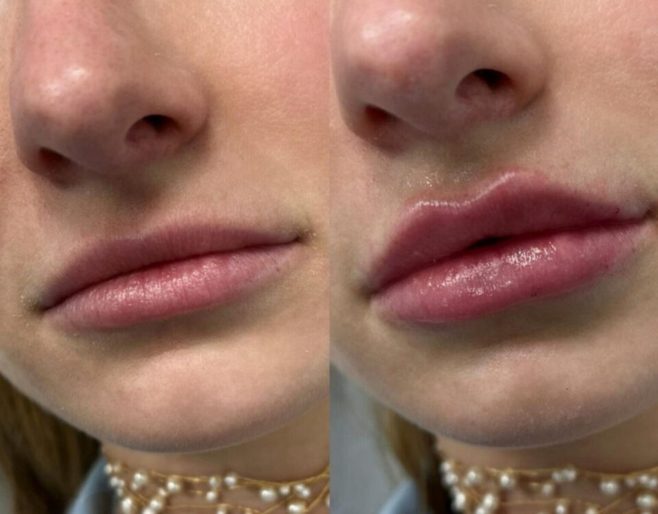 Preenchimento para Repor Volume dos Lábios