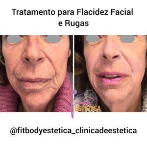 Tratamento para Flacidez Facial e Rugas com Fenol