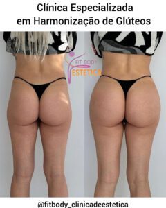 Clínica Especializada em Harmonização de Glúteo