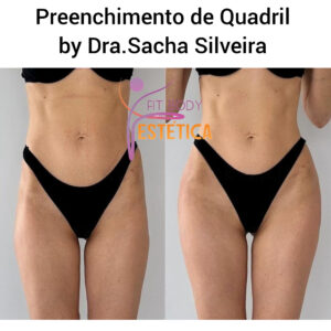 Preenchimento de Quadril by Dra.Sacha Silveira