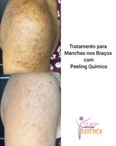 Peeling Químico para Tratar Manchas nos Braços