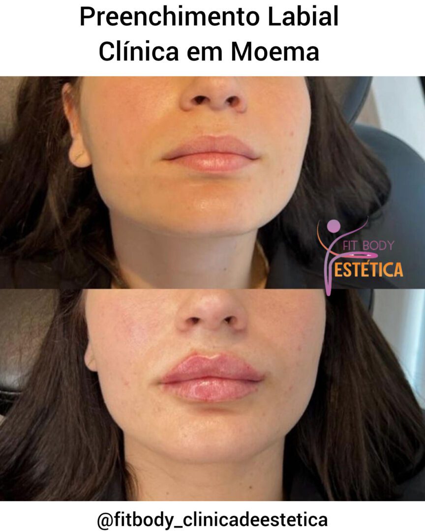 Preenchimento Labial Clínica Em Moema Clínica Fit Body Estética