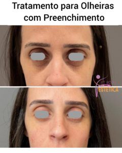 Tratamento para Olheiras com Preenchimento