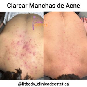 Clarear Manchas de Acne