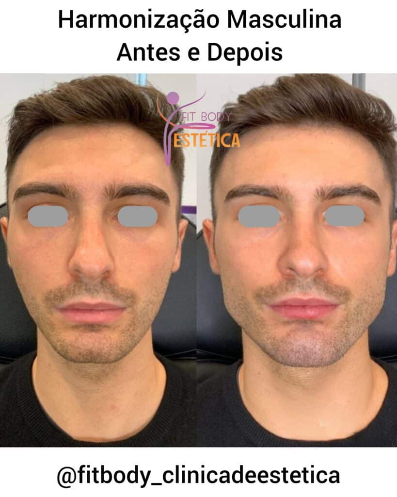 Harmonização Masculina Antes e Depois