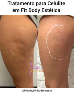 Tratamento para Celulite em Fit Body Estética