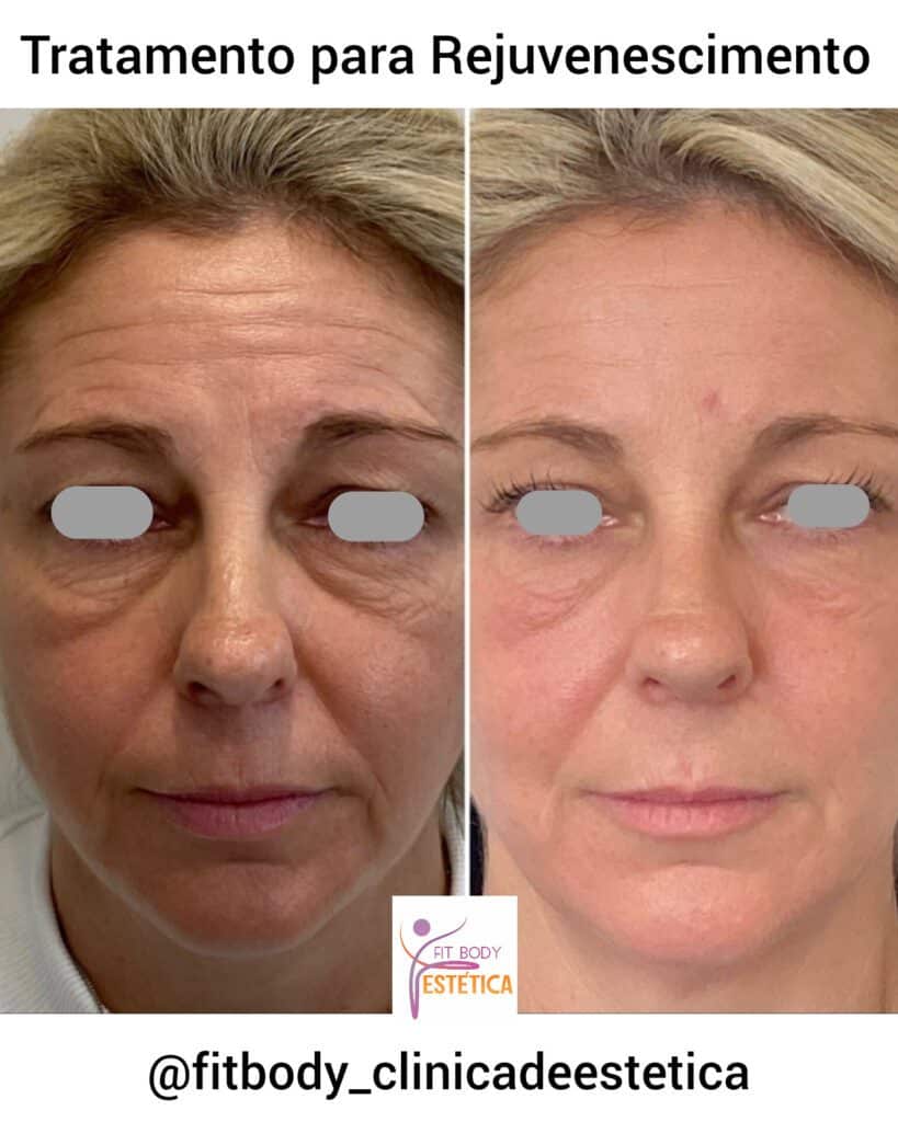 Melhor Tratamento para Rejuvenescimento