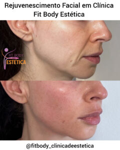 Rejuvenescimento Facial Clínica Fit Body Estética