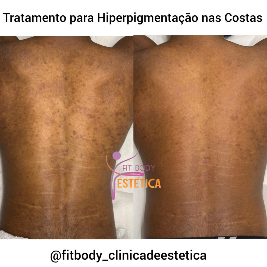 Hiperpigmentação nas Costas