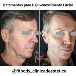 Melhores Tratamentos para Rejuvenescer o Rosto