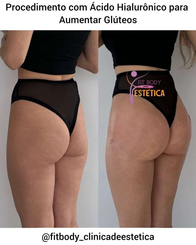 Procedimento para Aumentar Bumbum
