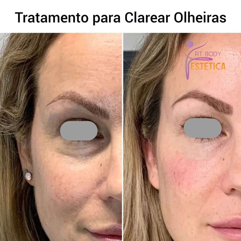 Tratamento para Clarear Olheiras