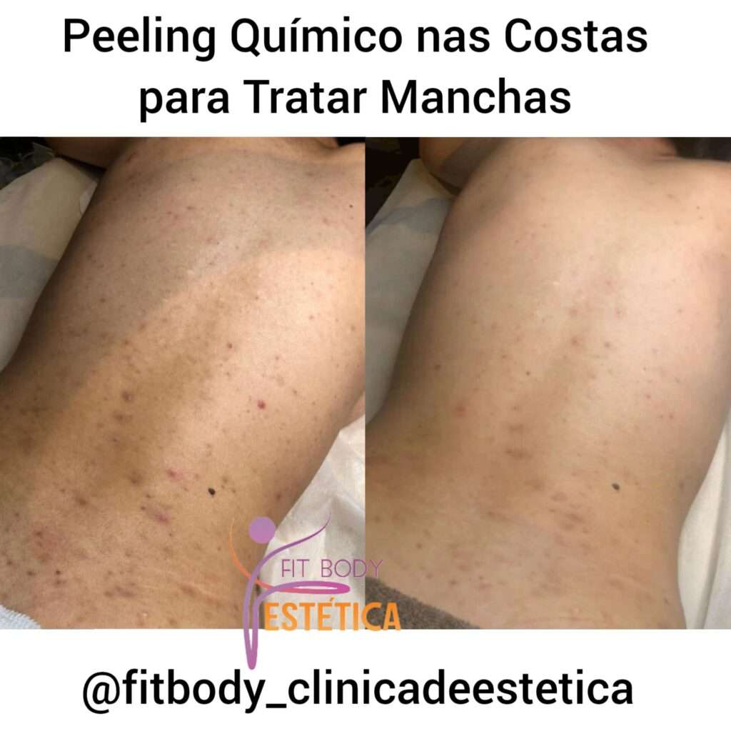Peeling Químico nas Costas para Tratar Manchas