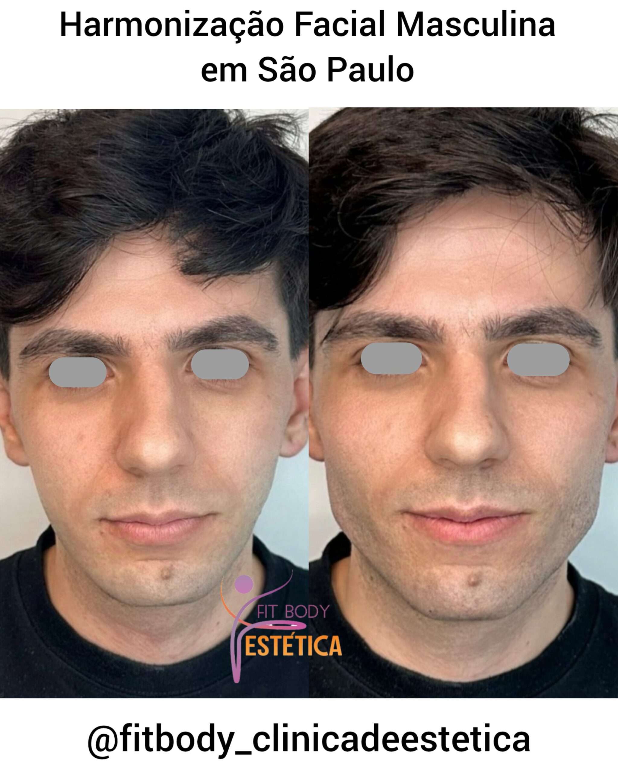 Harmonização Facial Masculina em São Paulo