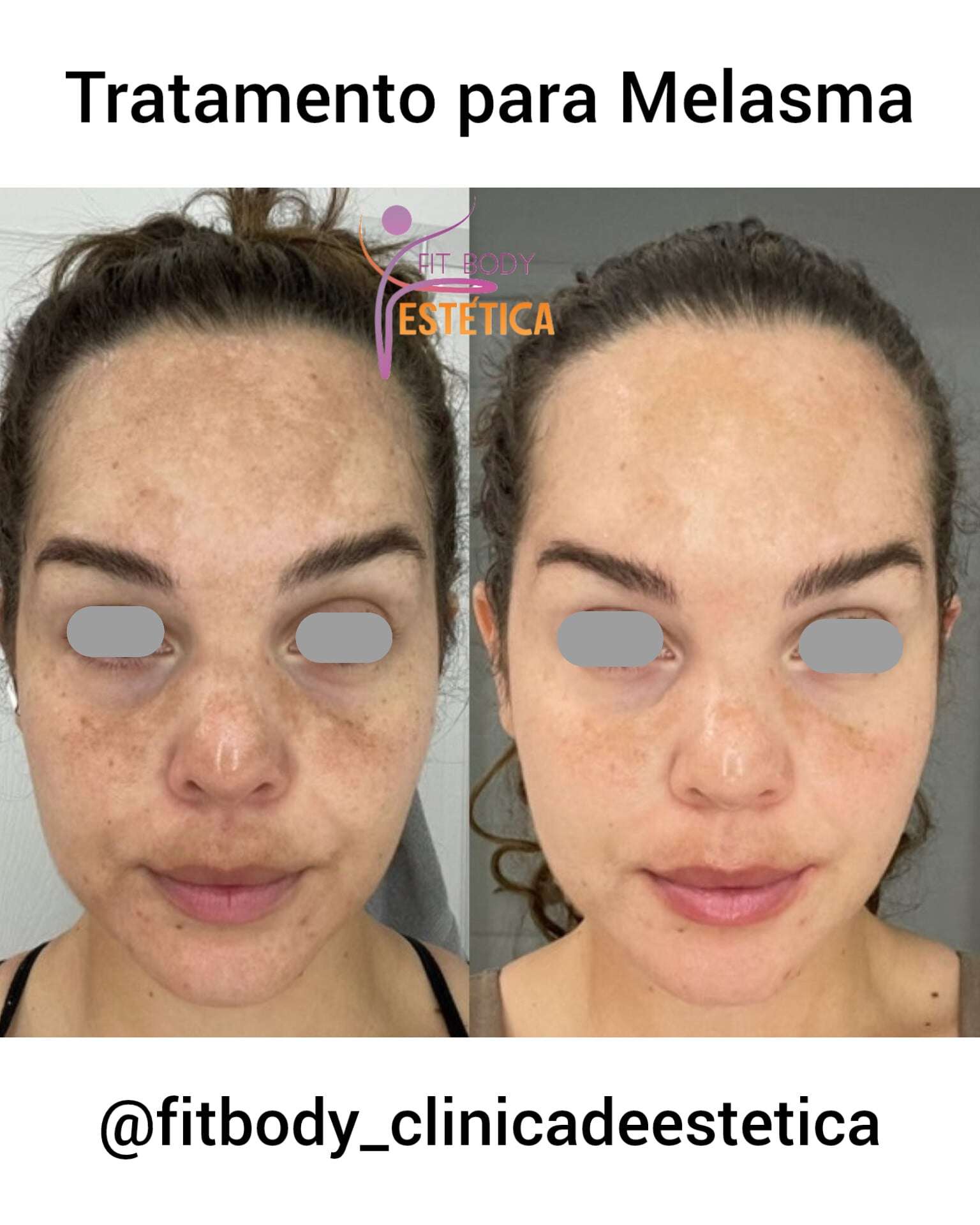 Melhores Tratamentos para Melasma