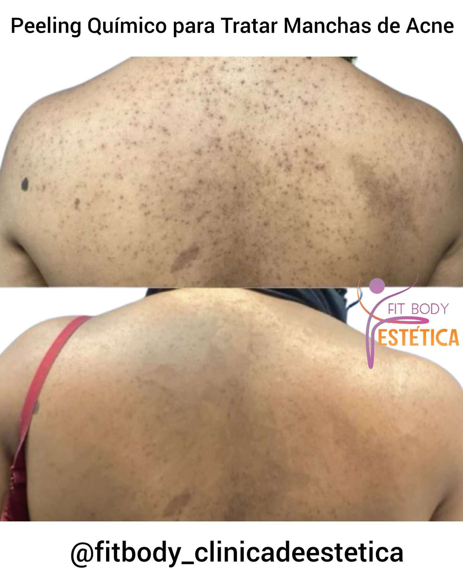 Peeling Químico para Tratar Manchas de Acne