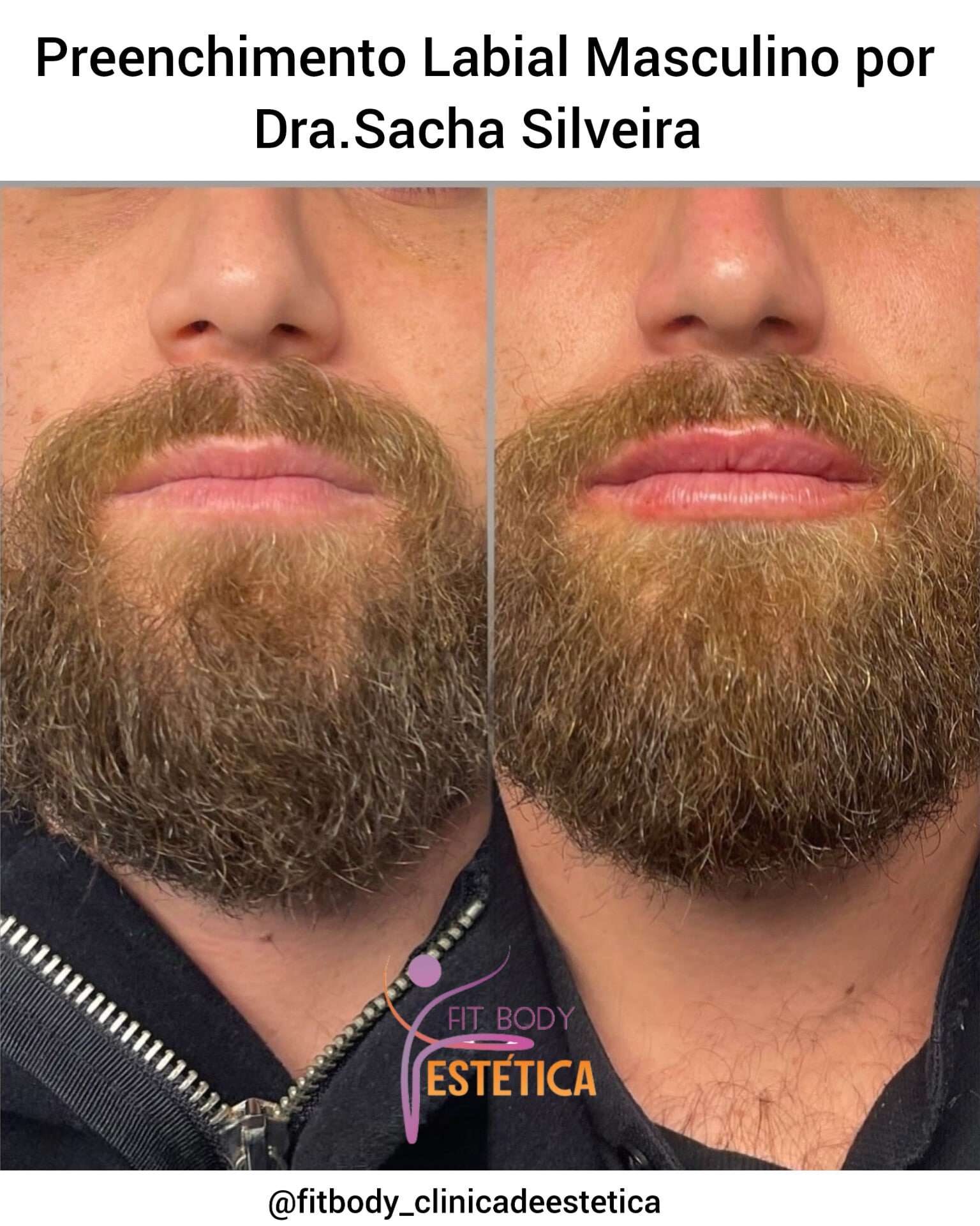 Preenchimento Labial Masculino by Dra Sacha Silveira