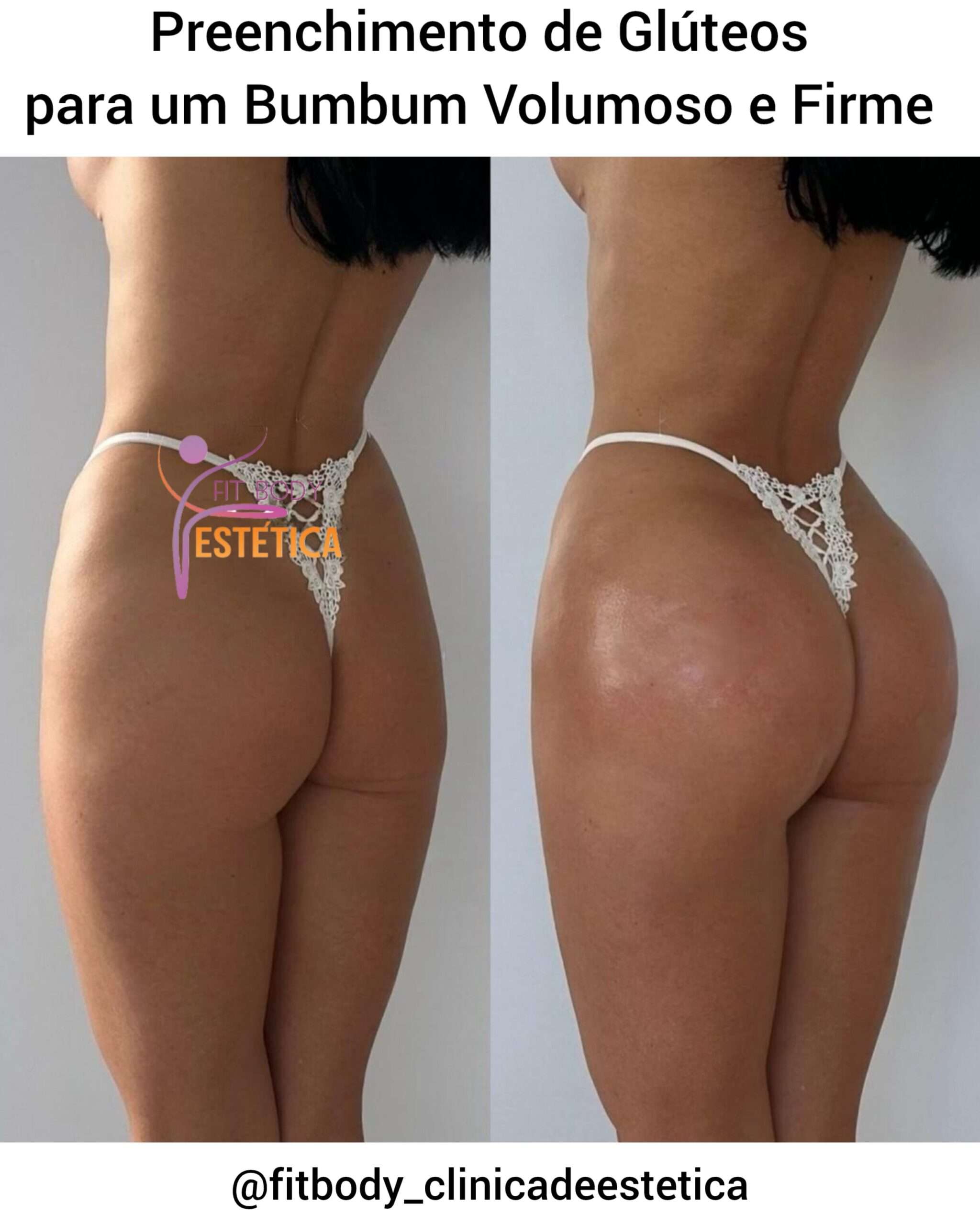 Preenchimento de Glúteos para um Bumbum Firme e Volumoso